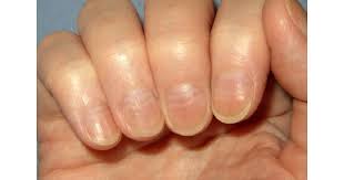 손톱에 세로줄이 생기는 이유