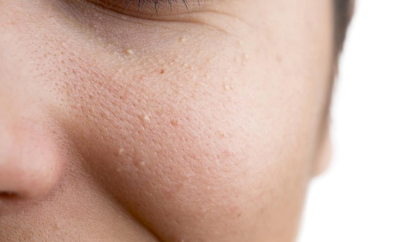 비립종 제거후 관리 방법 Tip 