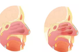 알레르기 비염 증상