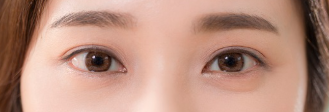 트임성형 종류, 윗트임은 무엇일까?