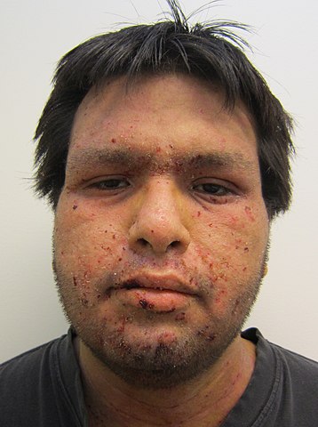 심각한 수준의 농가진 환자의 얼굴