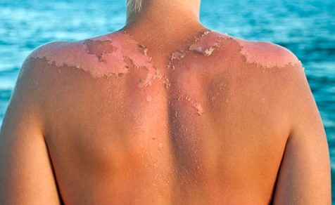 햇빛 피부 화상은 쉽게 넘기면 안됩니다