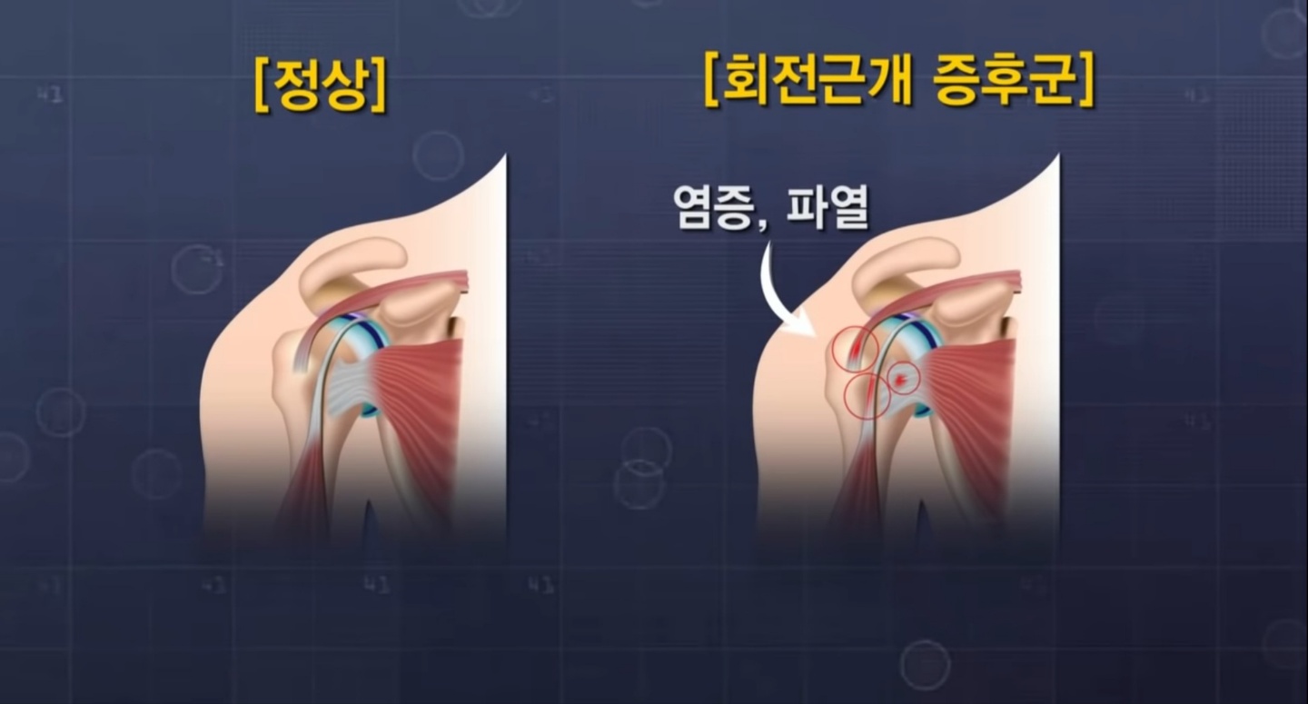 회전근개(왼쪽:정상/오른쪽:파열)
