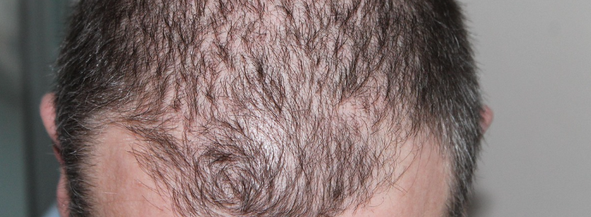 맥주효모의 탈모효과에 대한 유래