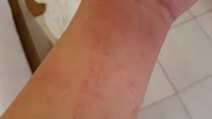 피부발진의 종류