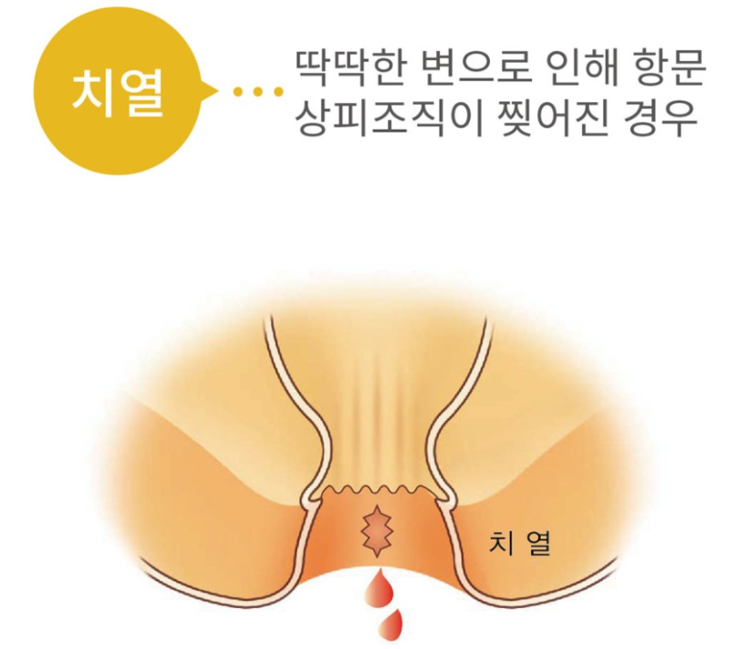 치열 증상