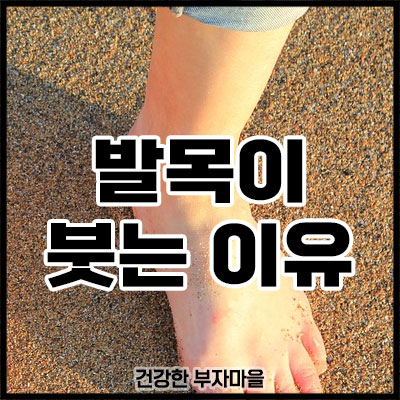 발목이 붓는 이유