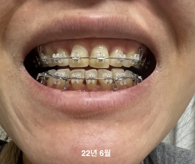 2년 7개월 교정 중 과개교합 돌출입 교정 일기