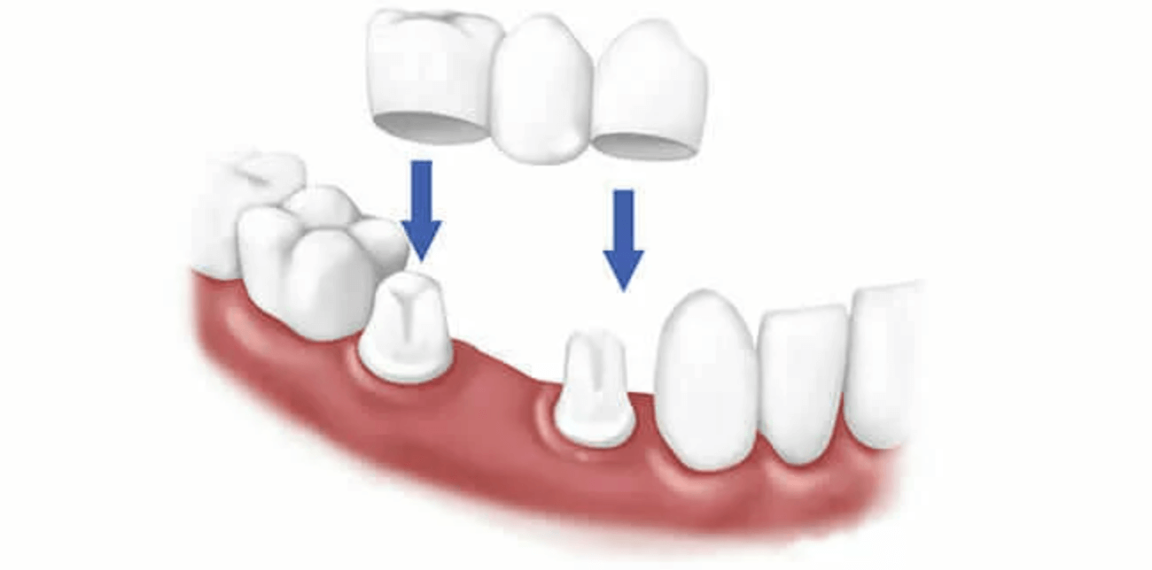 앞니 이빨 깨짐