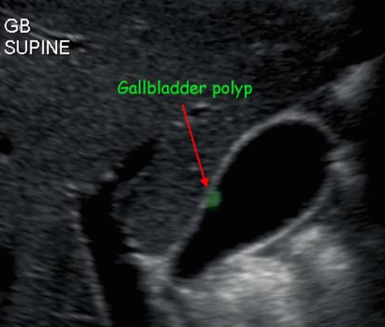 담낭 용종 ( GB polyp )