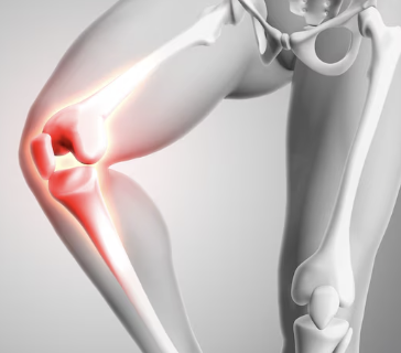 퇴행성관절염 증상 23