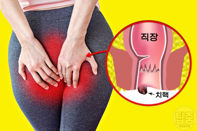 치질 좋은 운동 치질 안좋은 운동