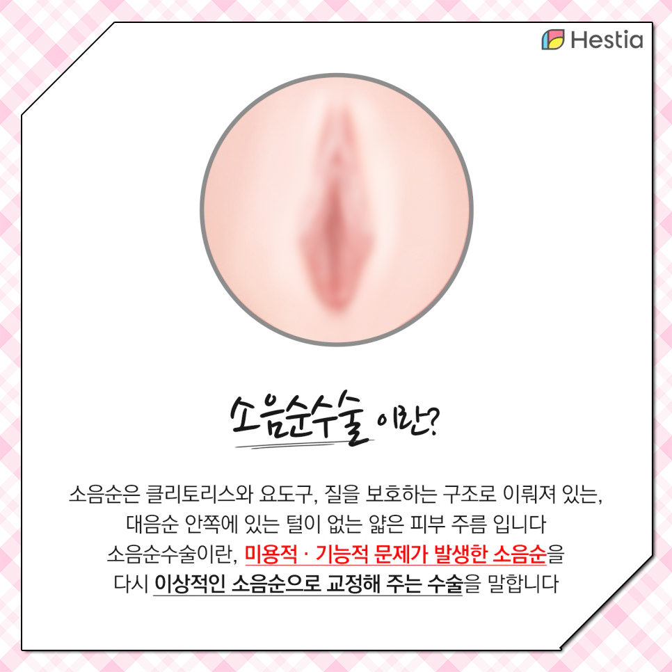 소음순수술이란?