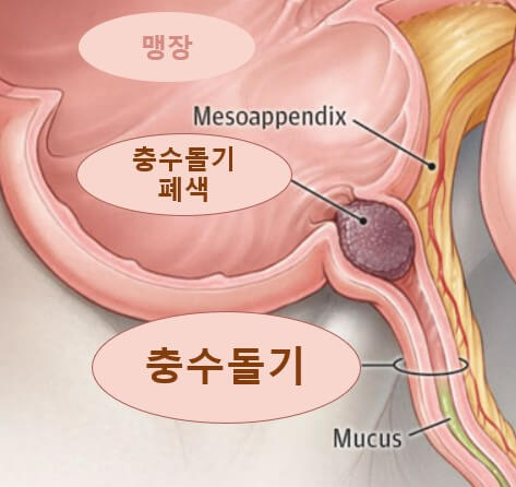 맹장염 초기 증상 5가지 및 맹장 위치