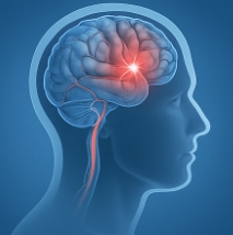 뇌졸중 전조증상