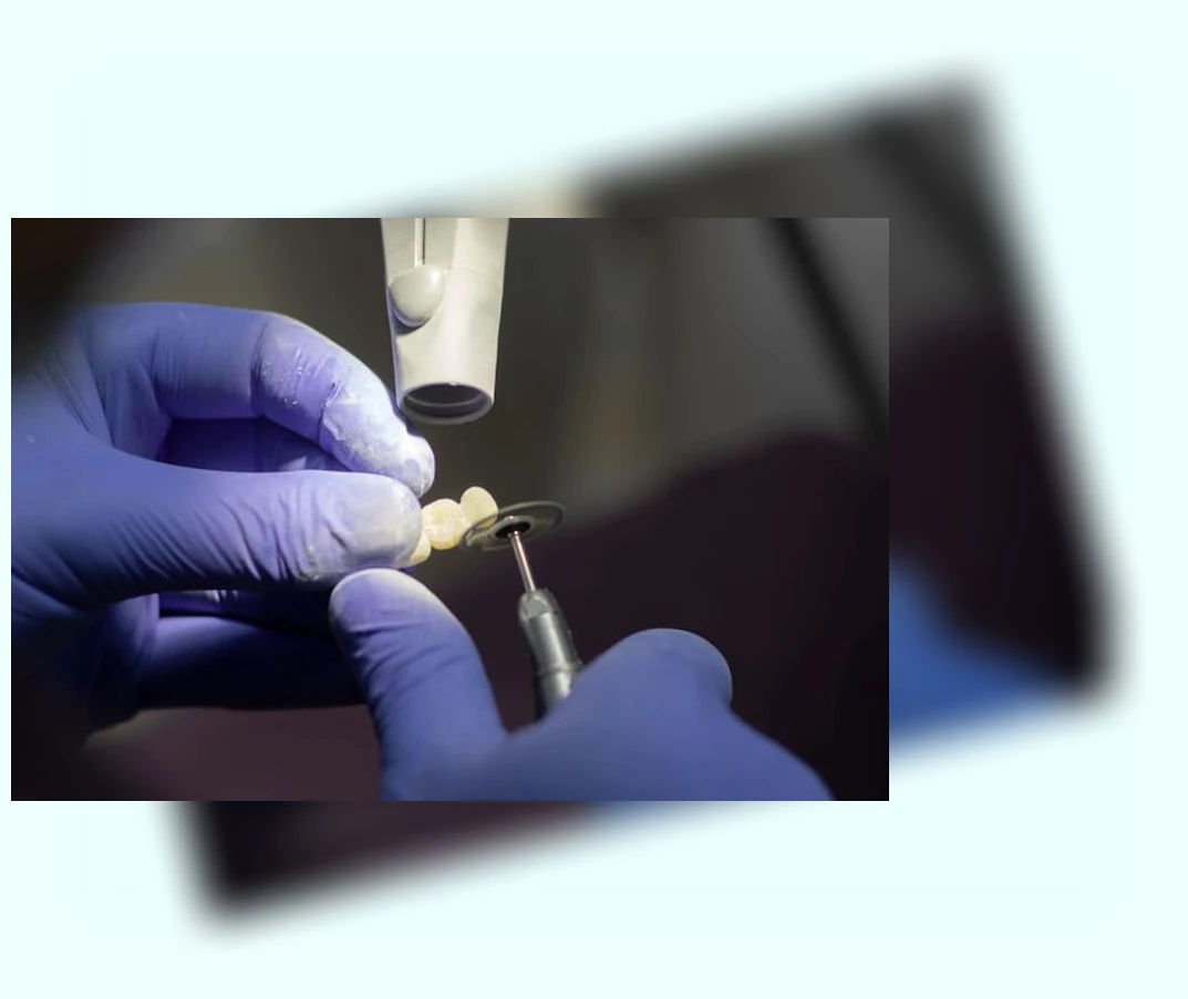 30대 전악 임플란트_4