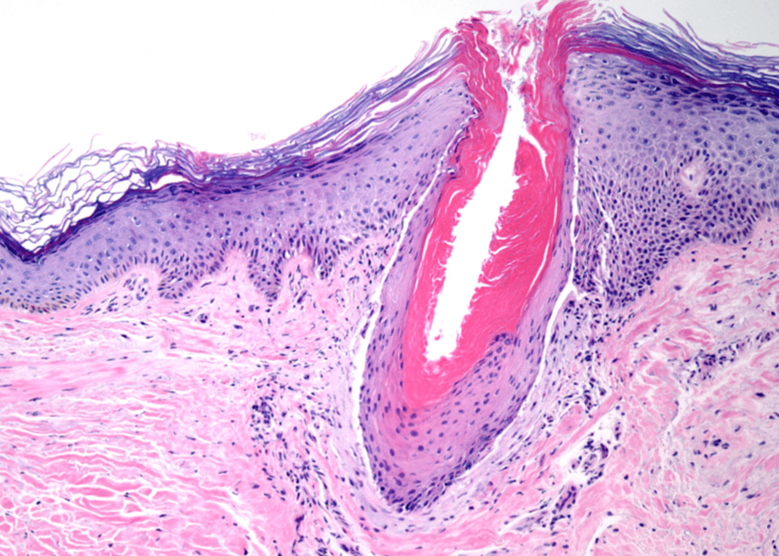 모공각화증 치료