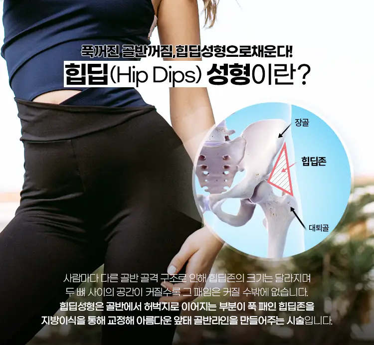 힙딥성형은 골반에서 허벅지로 이어지는 부분이 푹 패인 힙딥존을 지방이식을 통해 교정해 아름다운 앞태 골반라인을 만들어주는 시술입니다.