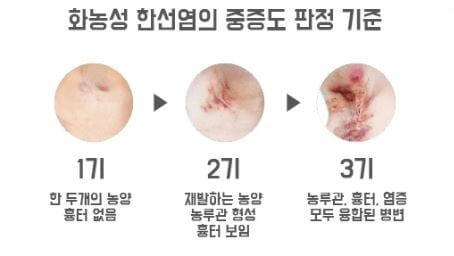 화농성 한선염 단계별 증상