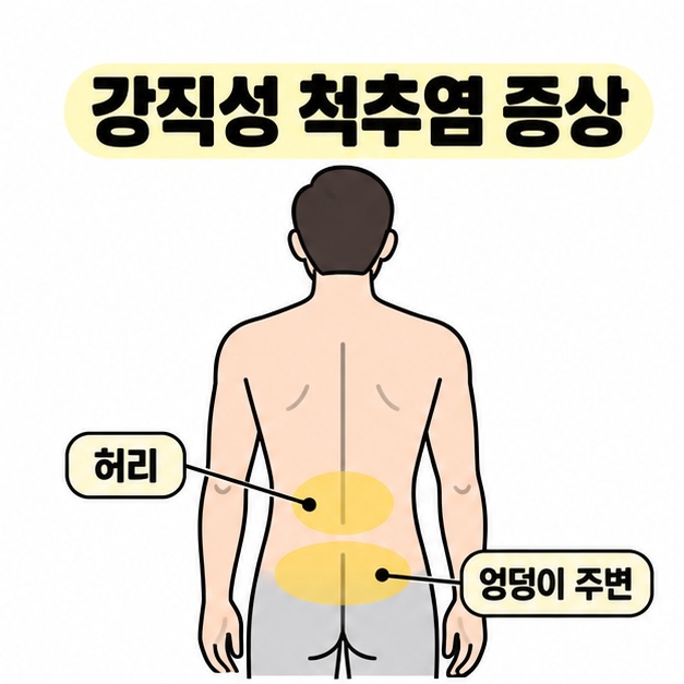 강직성 척추염 증상 제목 아래 뒷모습 인체의 허리와 엉덩이 주변을 노란색으로 표시한 대표 그림