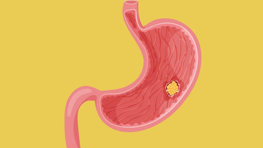 위 선종 예시 일러스트