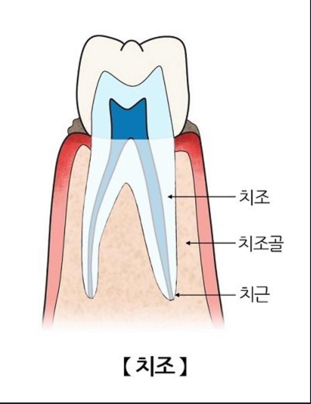 치조골이식수술임플란트사진