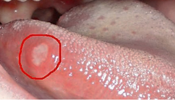 설암(혀암) 초기증상과 원인