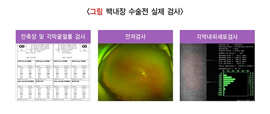 백내장