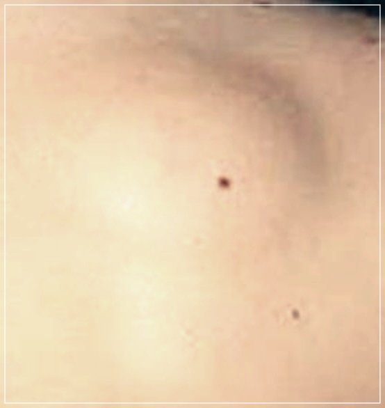 지방종 제거 수술: 원인, 절차, 비용