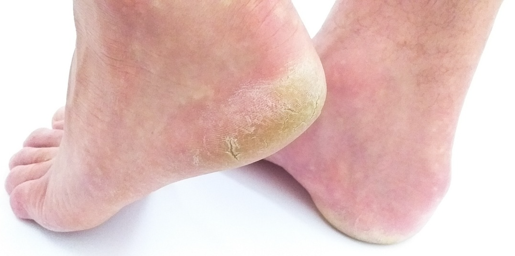 발 무좀 사진