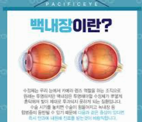 백내장 사진