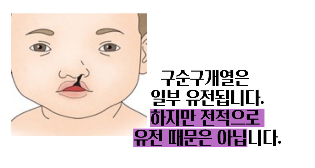 구순구개열 수술 유전