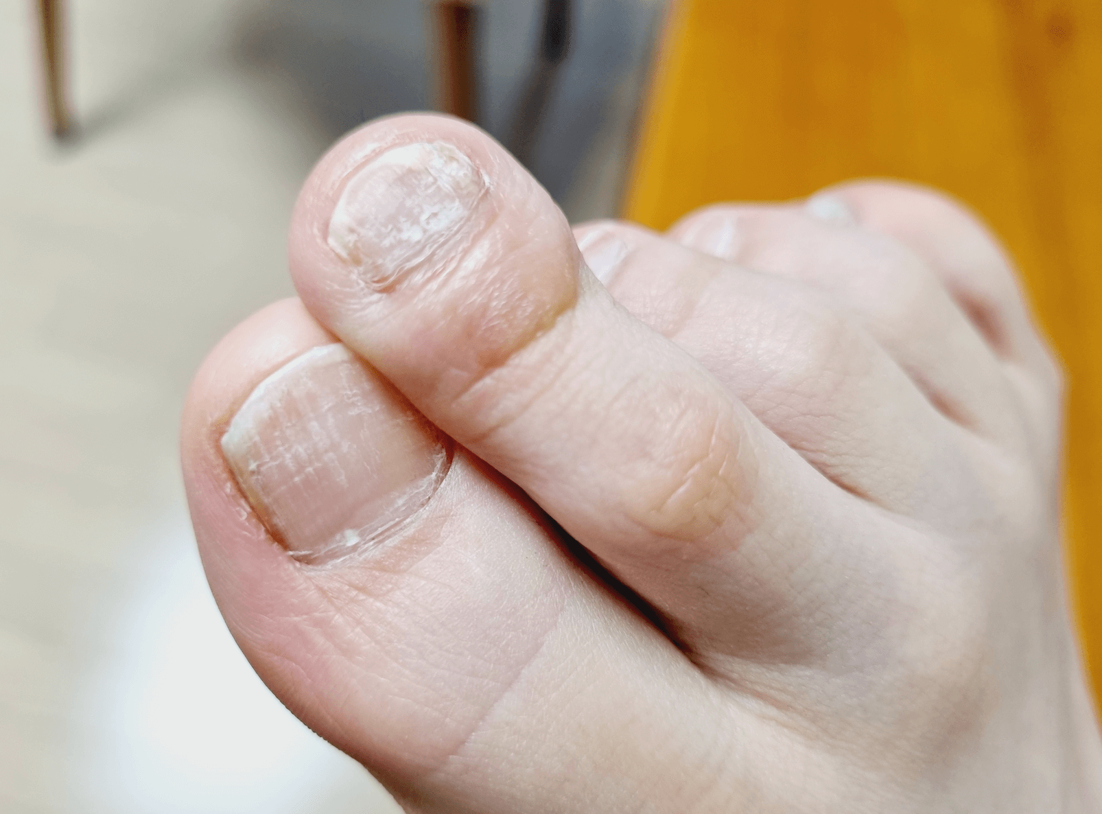 발톱무좀