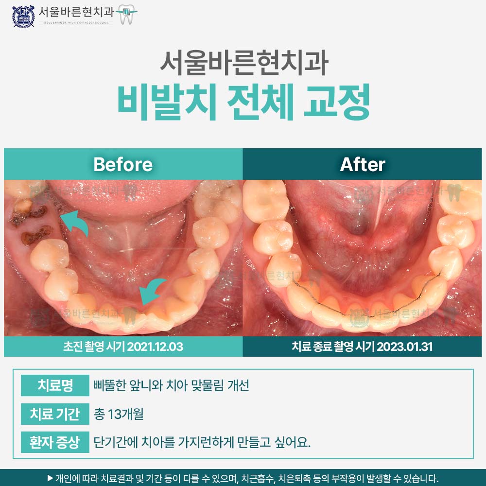 해운대치아교정