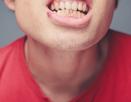 입안 구내염 원인 TOP 5