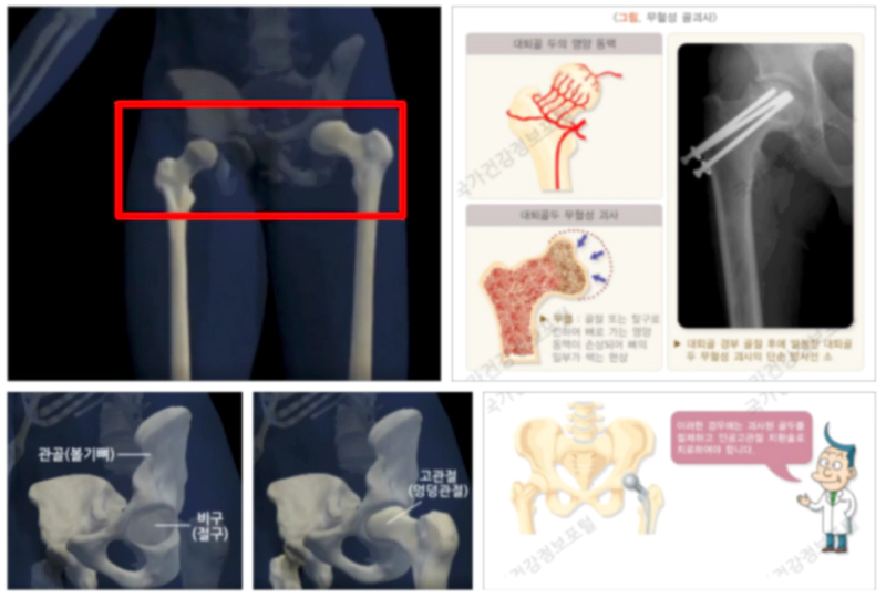 대퇴골두 무혈성 괴사