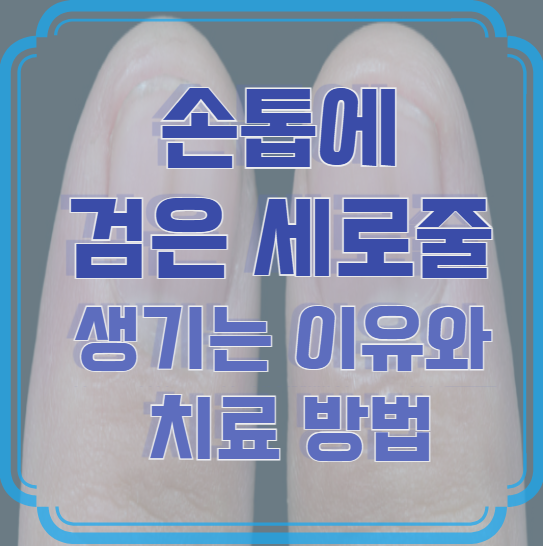 손톱에 검은 세로줄이 생기는 이유와 치료 방법