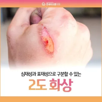 2도 화상 증상 자가치료 회복기간 응급처치법 정리_3