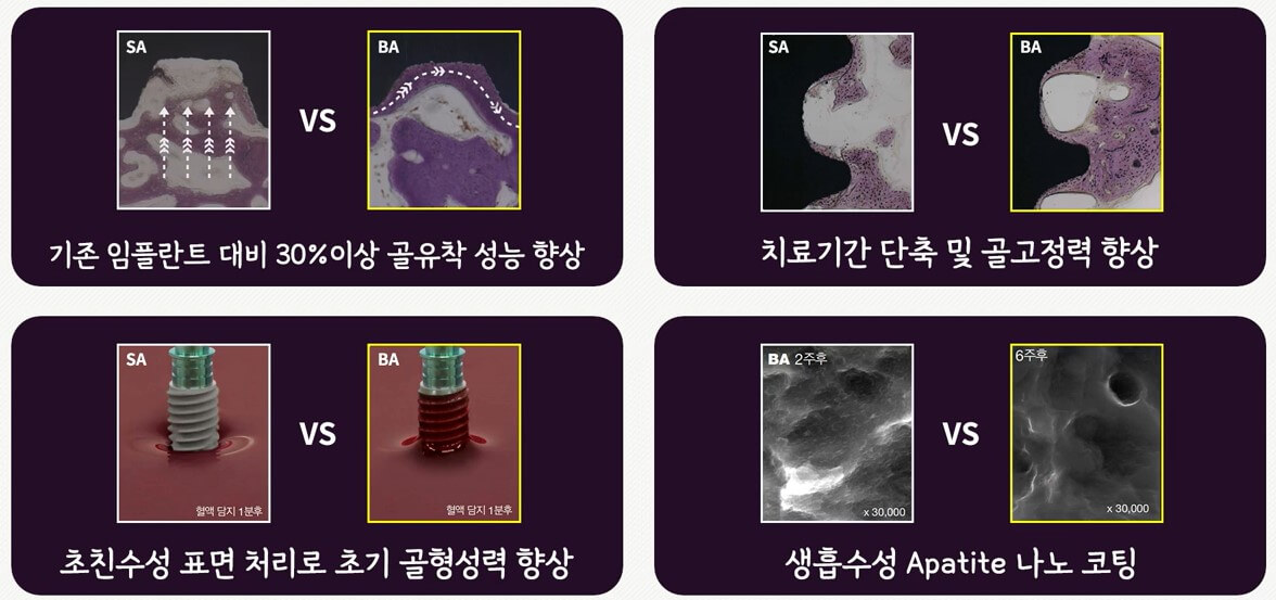 BA 임플란트 장점