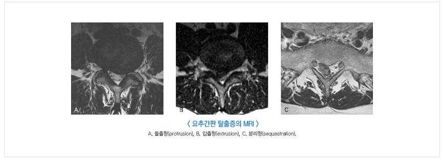 허리-디스크-증상