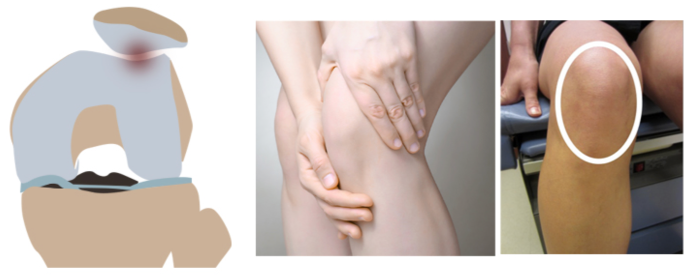 슬개대퇴과압박증후군/슬개대퇴동통증후군