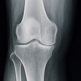 무릎 연골 손상 증상