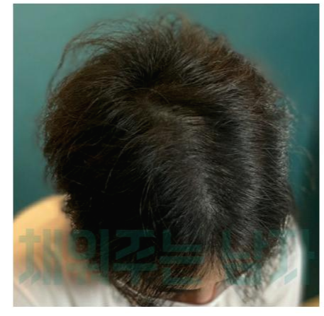 두피문신 애프터