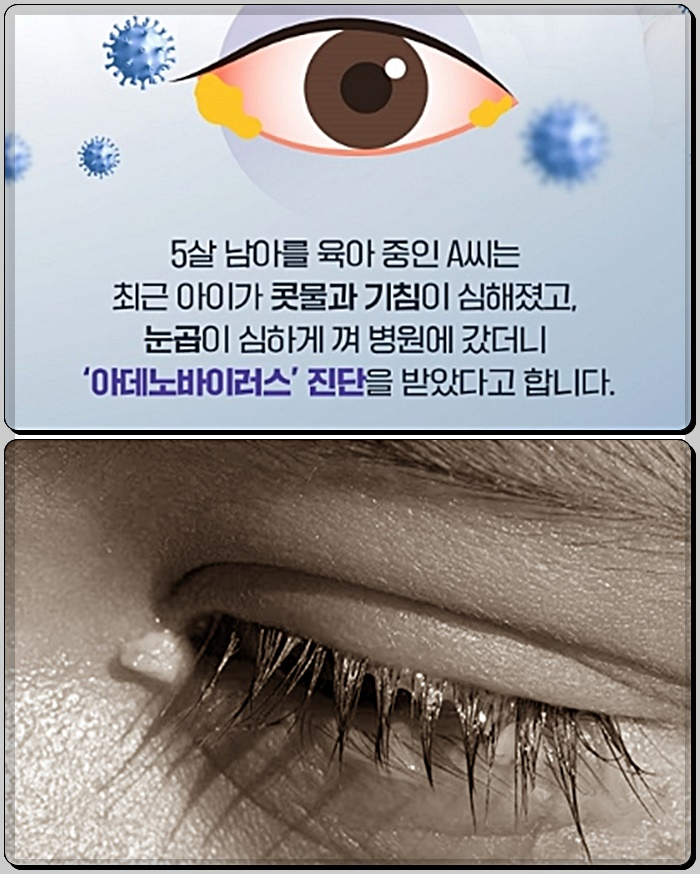 아데노바이러스-증상-눈곱