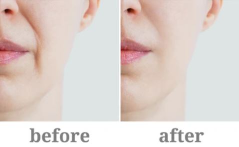 팔자주름 없애기 위한 방법