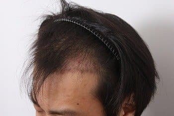 모발이식 후기
