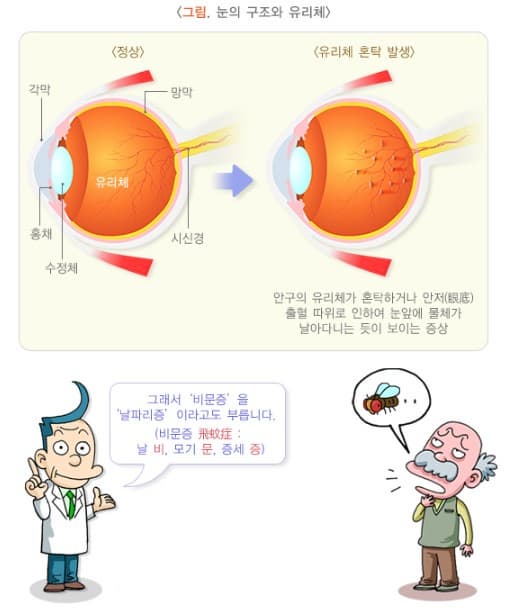 비문증 원인 증상 치료방법 알아보기