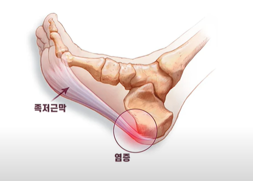 발바닥통증의 원인과 부위별 설명 병원 선택 정보