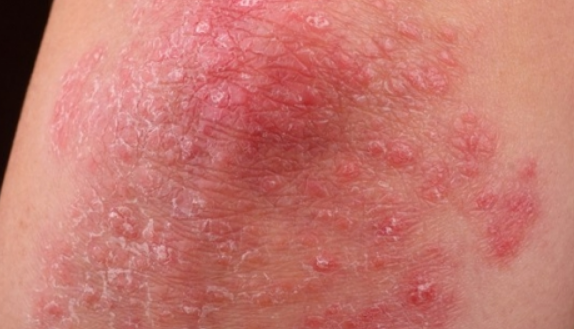 습진