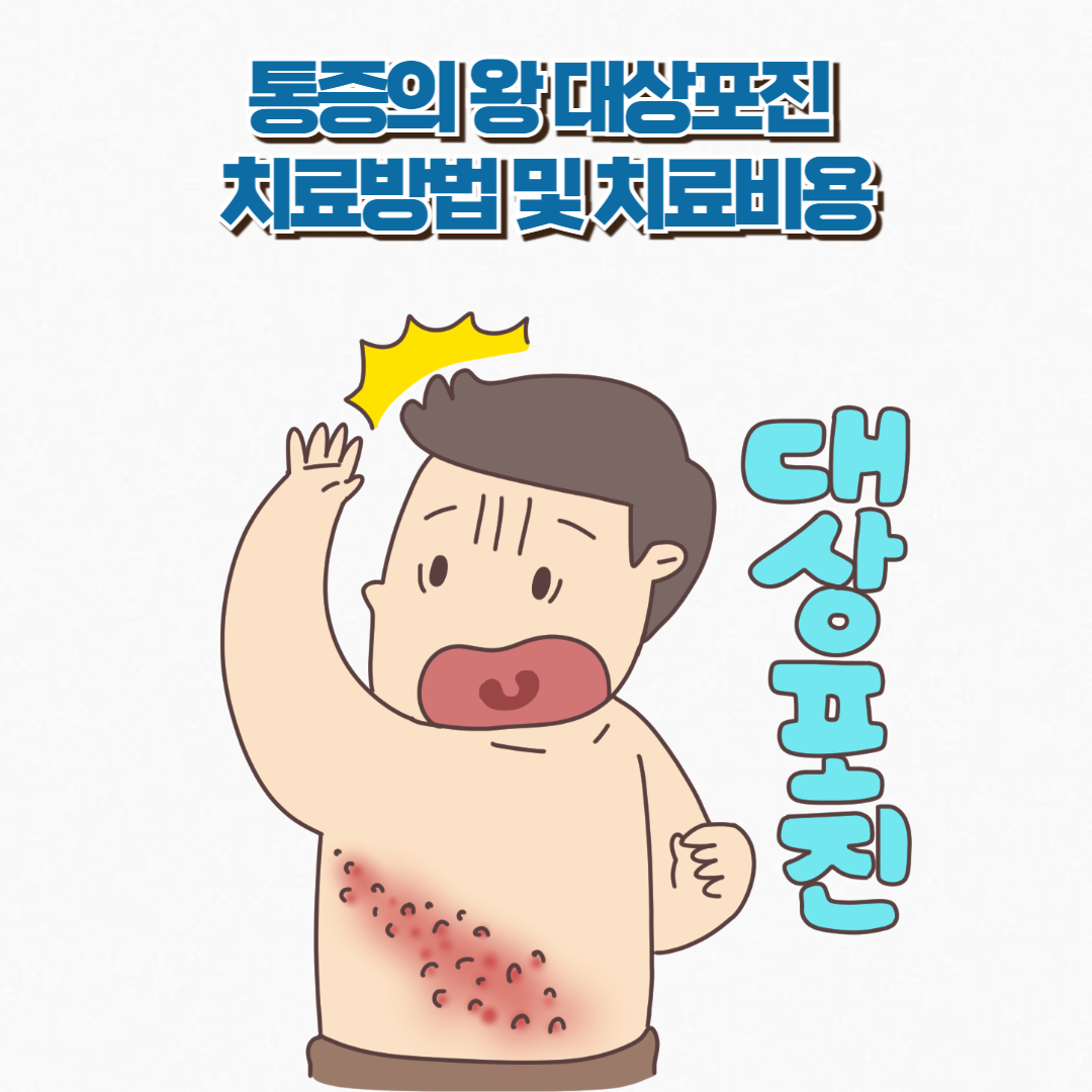 대상포진 치료방법 및 치료비용